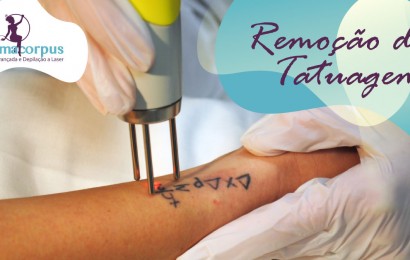 Pacote de 4 Sessões Remoção de Tatuagem